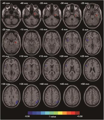 Interaction of Gut Microbiota and Brain Function in Patients With Chronic Insomnia: A Regional Homogeneity Study